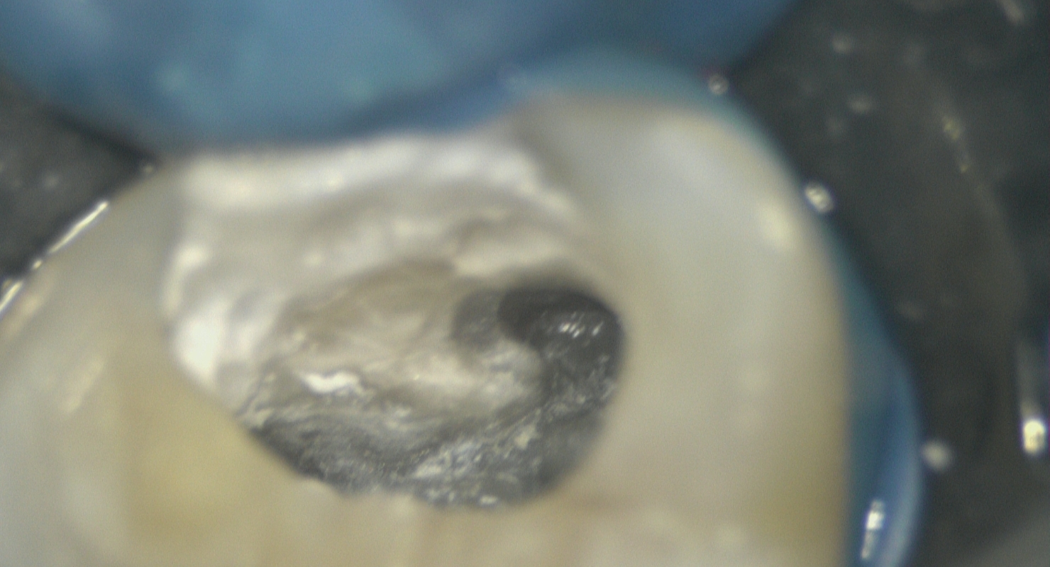 実際の歯科マイクロスコープで見た様子　写真3